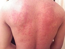 এলার্জী বিষয়ে ড. জে চি নাথে কি পৰামর্শ দিলে চাও আহক (Doctor advice for allergies by Dr G C Nath of medicity hospital Guwahati)