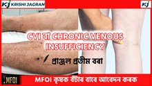 CHRONIC VENOUS INSUFFICIENCY  ৰোগৰ লক্ষণ আৰু সমাধান CHRONIC VENOUS INSUFFICIENCY  ৰোগৰ লক্ষণ আৰু সমাধান