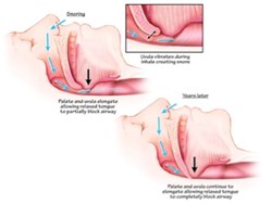 Snoring and its causes