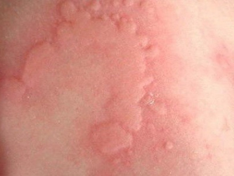 Allergies treatment on human body