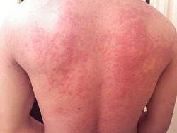 Know all about the allergies symptoms doctor advice medicine treatment and many more in detaila