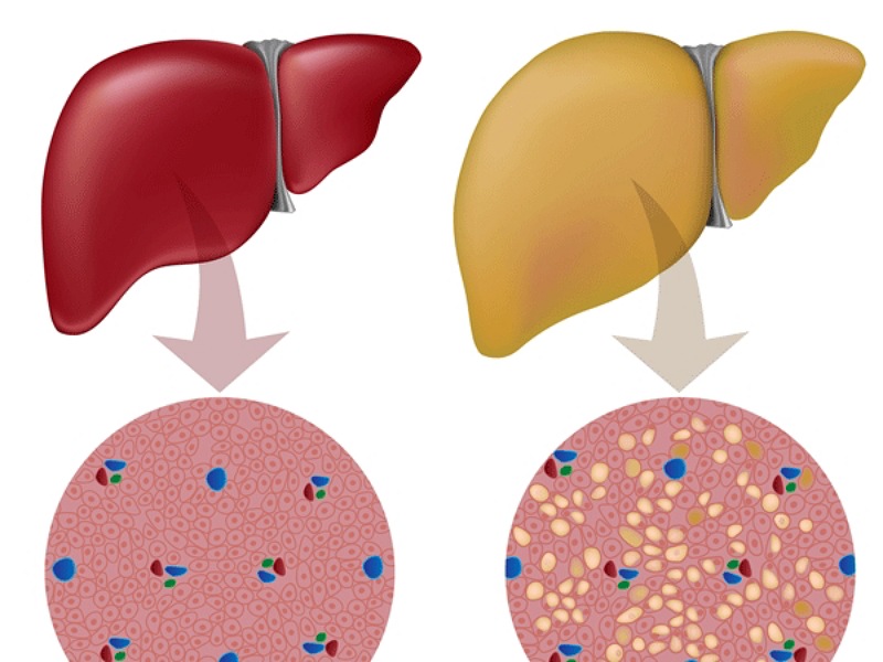 Control fat in liver