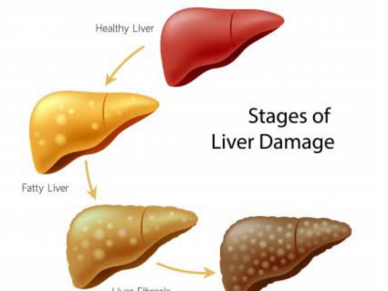 Fatty liver