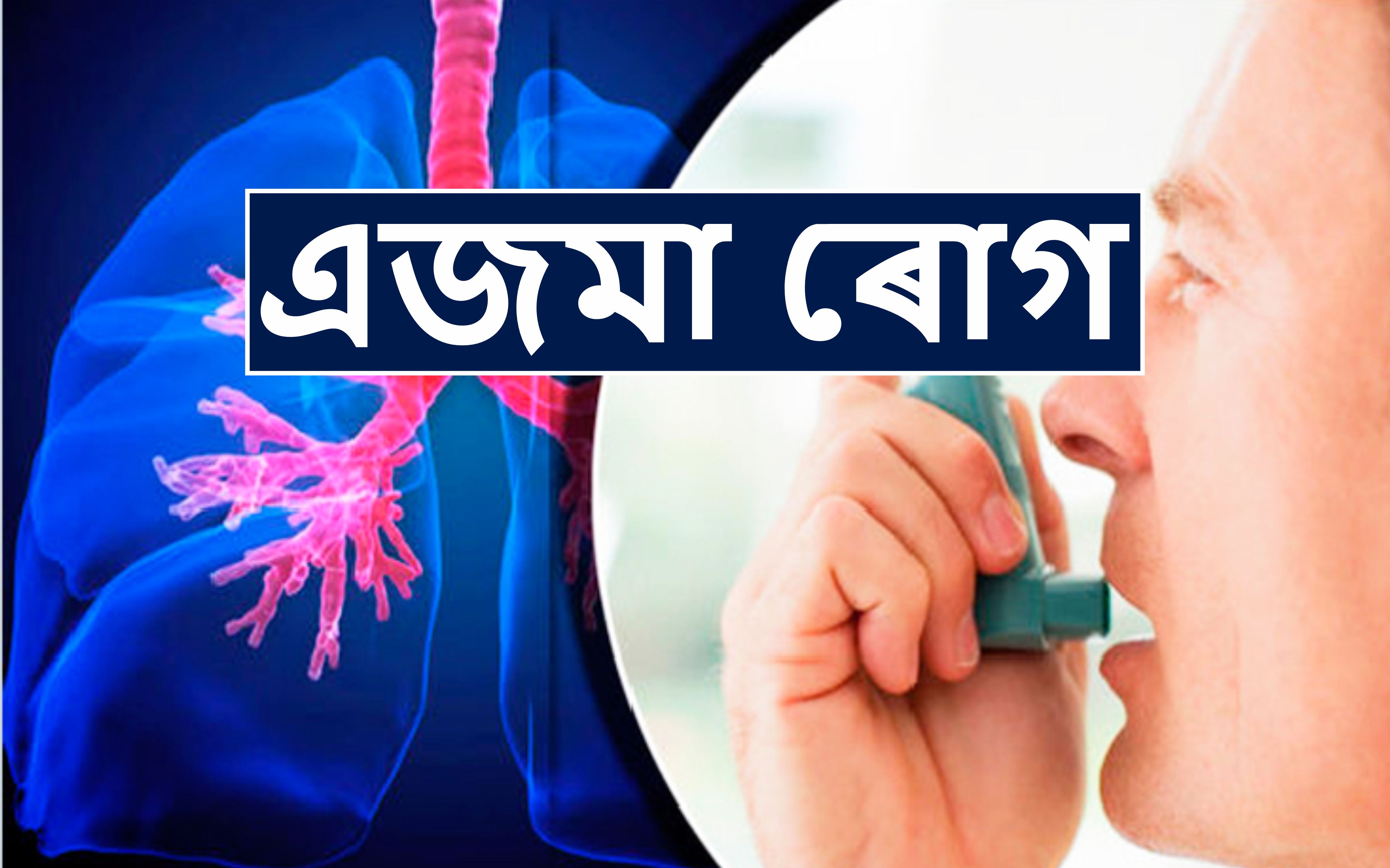 Asthma Disease