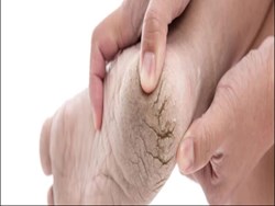 Winter Health Problem  : Cracked ankle